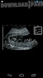 prenatal ultrasound lite
